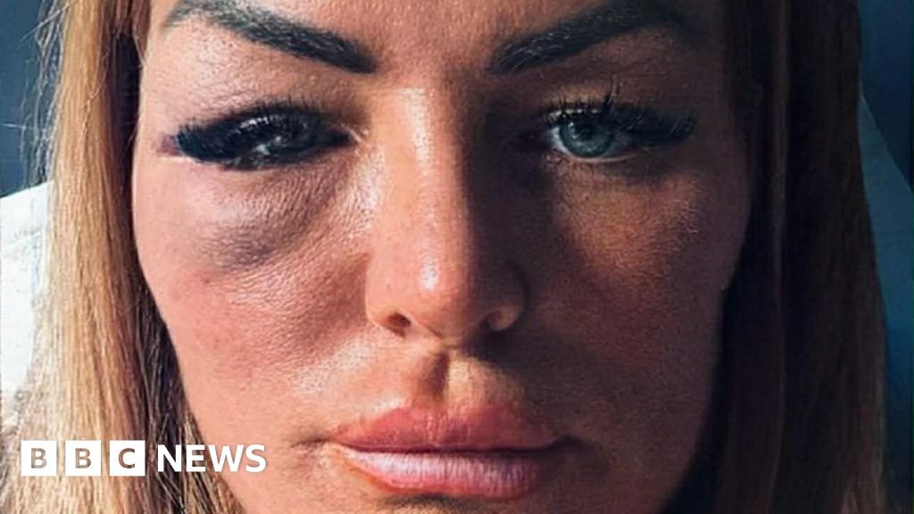 I turned down MMA fighter on a night out – so he punched me
