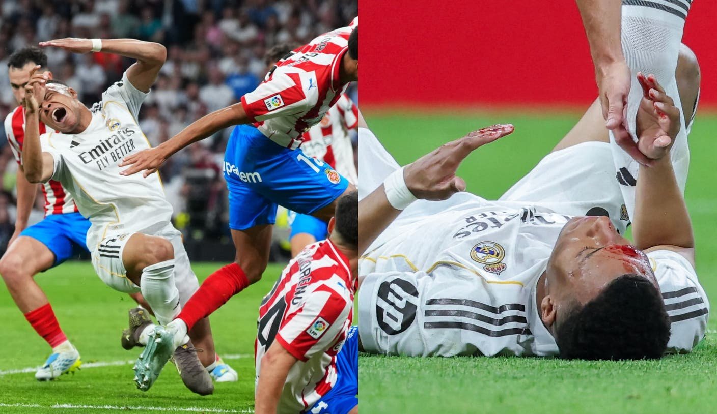 That’s Gotta Hurt! Real Madrid’s Kylian Mbappé Left With Bloody Gash