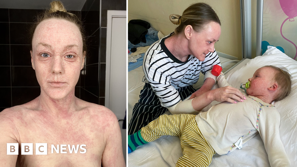Hundreds contact BBC about mystery skin condition 'hell' – but doctors can't agree it exists