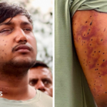 CJP protest: India’s ‘Cockroach’ protesters have wounds consistent with pellet-gun fire, experts say