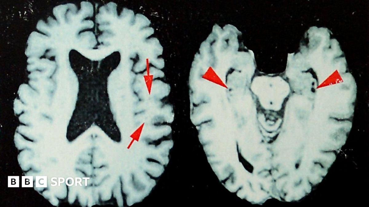 NFL: At least one in four dead players had brain disease, says study