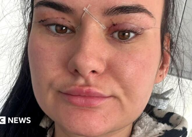 Open wounds and eyes that can’t close – women warn about cheap bleph eyelid surgery